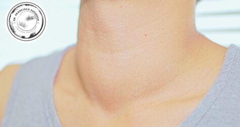 Bulto en el cuello