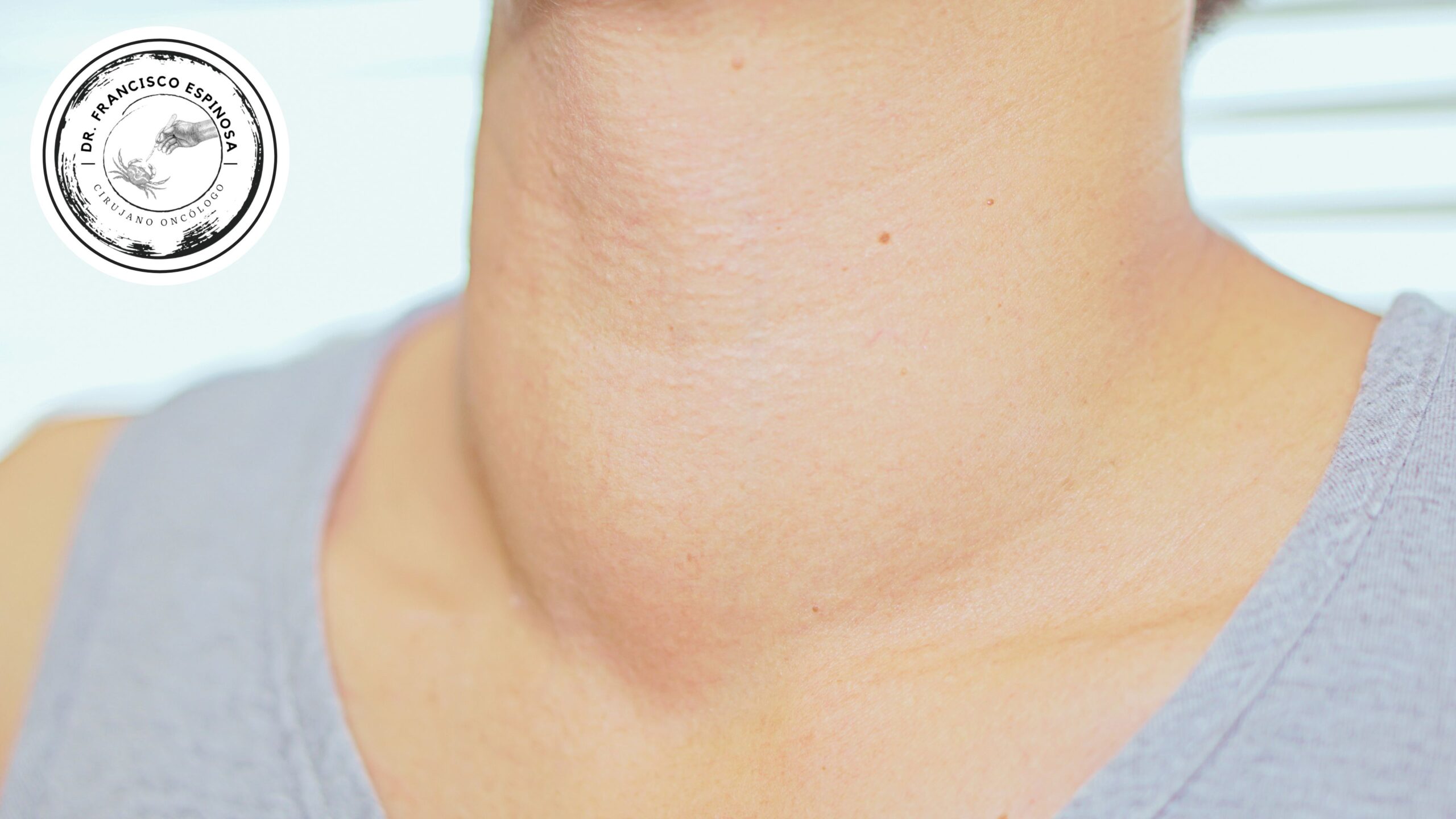 Bulto en el cuello Bulto en el cuello