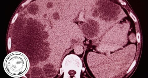 Diferencia entre Tumor Benigno y Maligno Diferencia entre Tumor Benigno y Maligno
