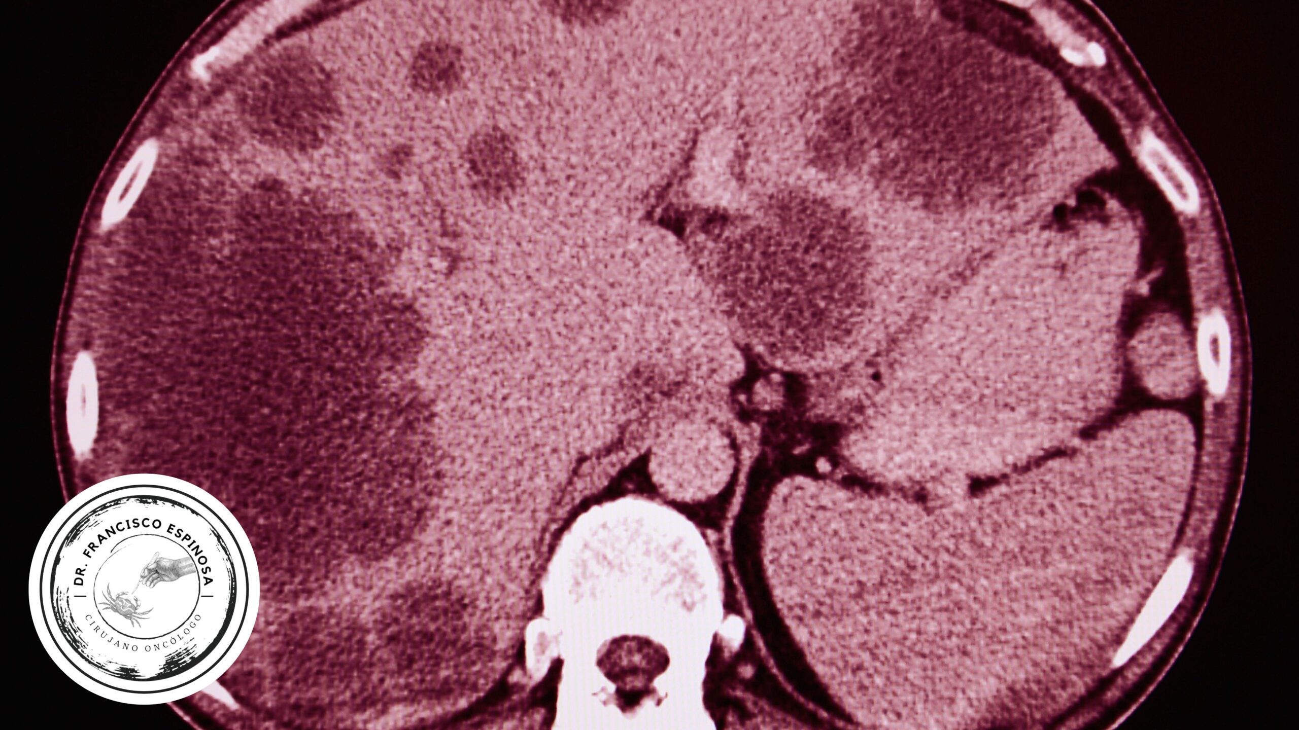Diferencia entre Tumor Benigno y Maligno Diferencia entre Tumor Benigno y Maligno