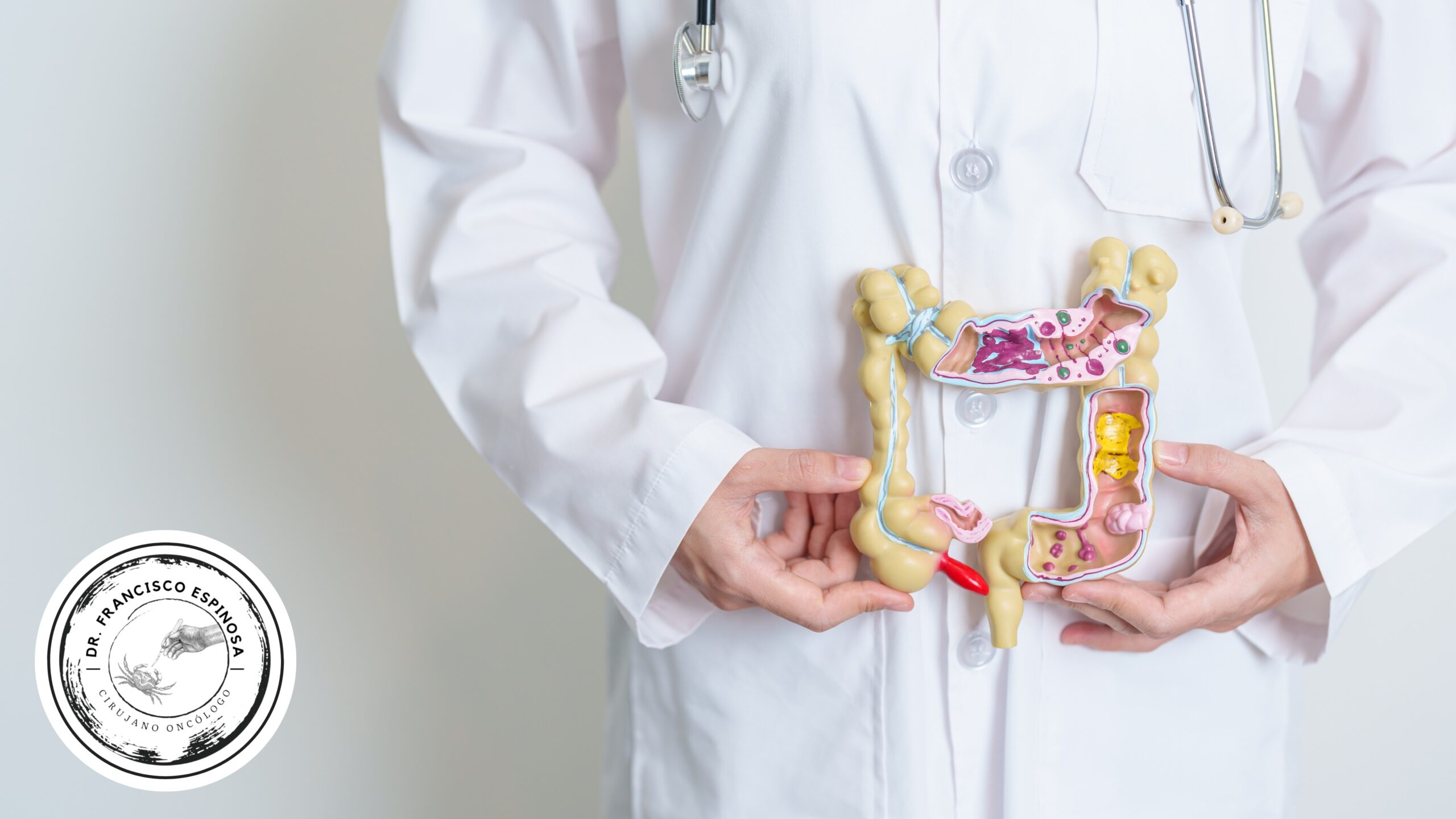 Cáncer de colon Cáncer de colon