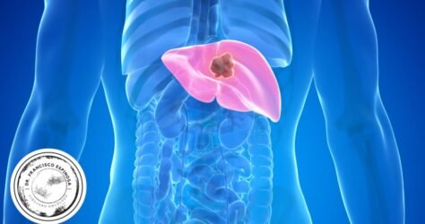 cáncer de hígado