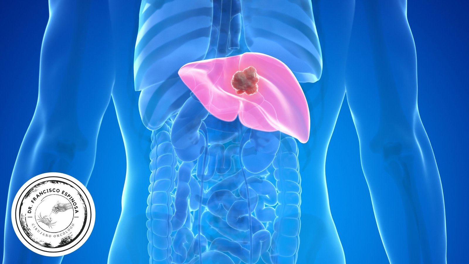 cáncer de hígado cáncer de hígado