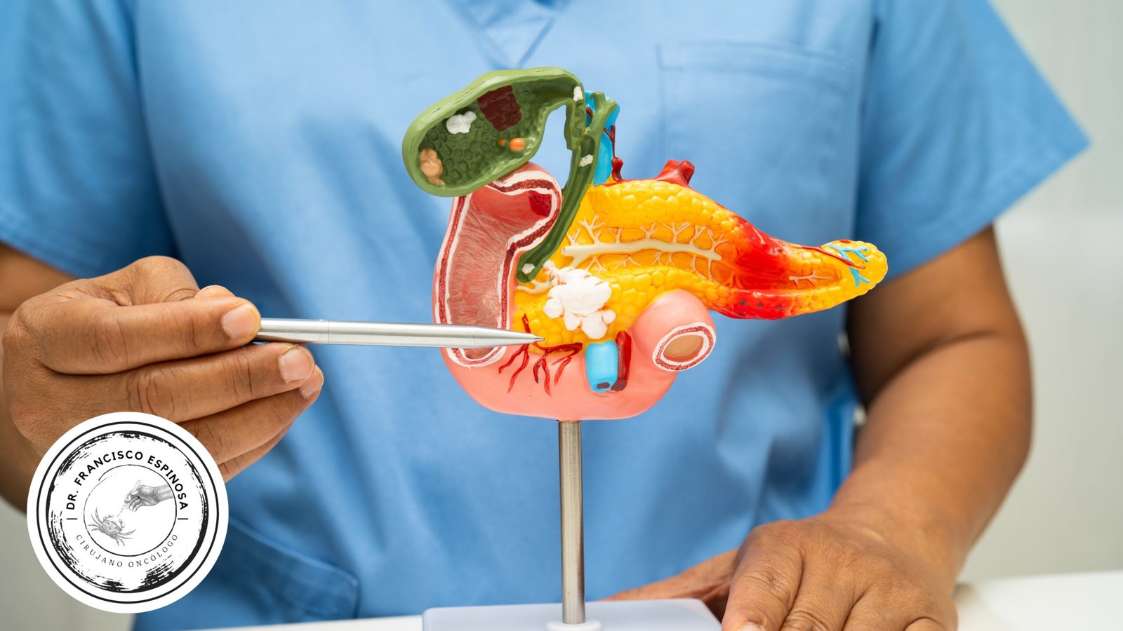 Cáncer de páncreas Cáncer de páncreas